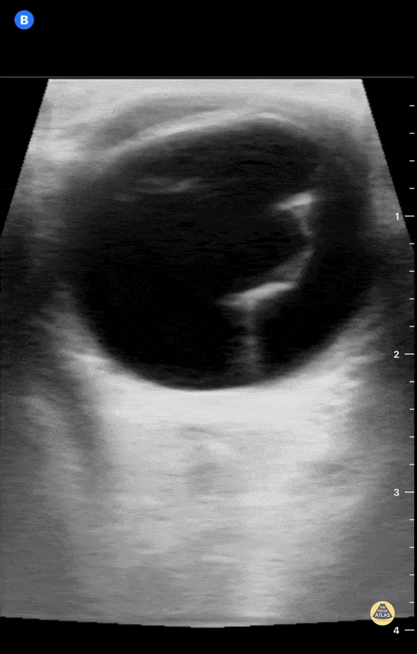 Orbital - Retinal Detachment - Test