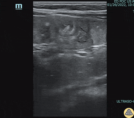 Peds-Gastrointestinal - Meckel's Diverticulum