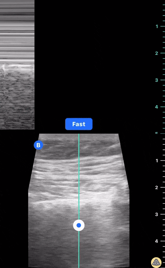 Pulmonary - Lung Slide M-mode