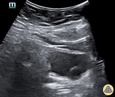 Renal/GU - Ureterocele