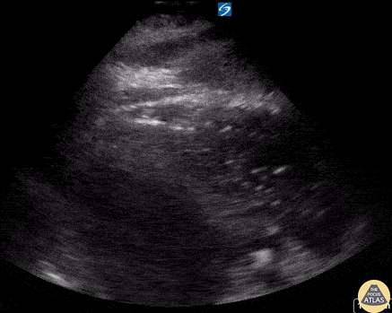 Other Cardiac Pathology - Retained Intracardiac Air