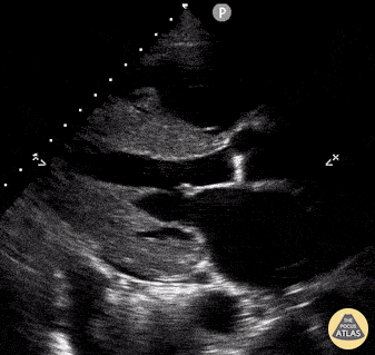 Other Cardiac Pathology - Cardiac Amyloidosis