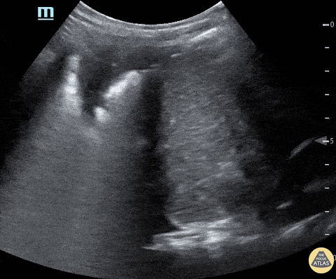 Peds-Lung - Acute Chest Syndrome
