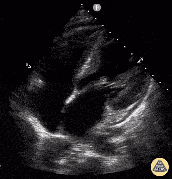 Thoracic Aortic Dissection & Aneurysm - Descending Thoracic Aorta Flap Seen on Apical 4 Chamber
