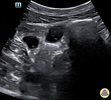 Bowel-GI - Normal Bowel Peristalsis