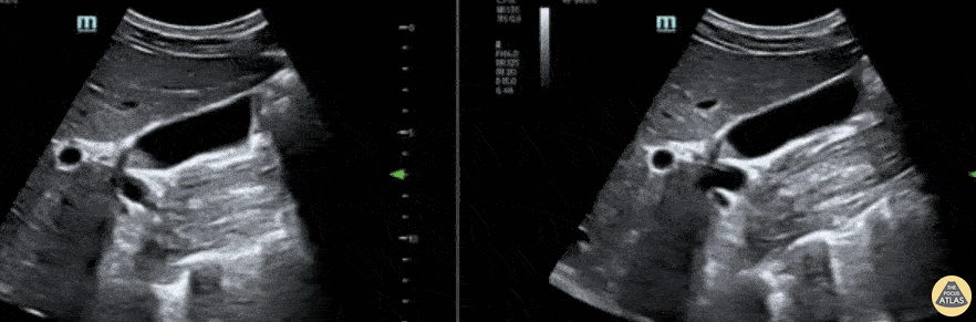 Biliary - Gallbladder Polyp