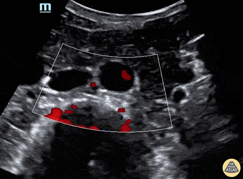 Biliary - RUQ Color Doppler