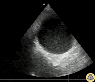 Biliary - Pancreatic Pseudocyst