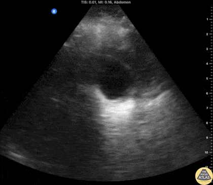 Biliary - Impacted Gallbladder Neck Stone
