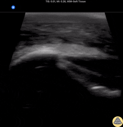 Soft Tissue - Deep Cellulitis with Phlegmon