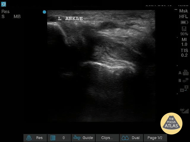 Musculoskeletal - Complex Left Ankle Effusion