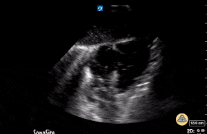 Peds-Cardiac - Cardiac Standstill