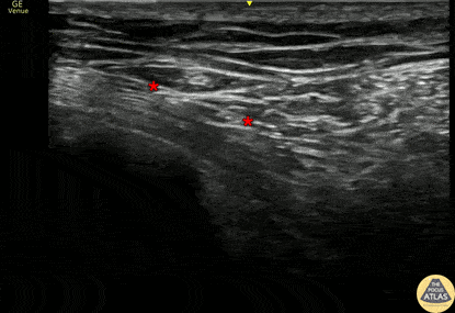 Nerve Block Gallery - Serratus Anterior Plane Block for Rib Fractures