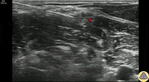 Nerve Block Gallery - Interscalene Nerve Block for Shoulder Dislocation