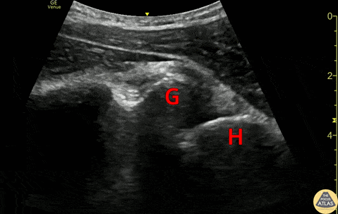 Musculoskeletal - Anterior Shoulder Dislocation