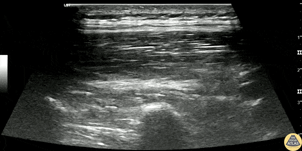 Nerve Block Gallery - Erector Spinae Plane Block for Pancreatitis