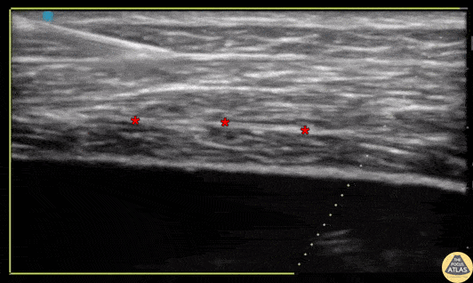 Nerve Block Gallery - Transversus Abdominis Plane Block