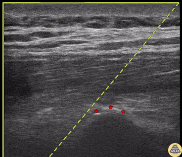 Nerve Block Gallery - Erector Spinae Plane Block Approach