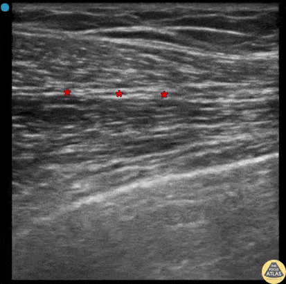 Nerve Block Gallery - PECS 1 Block