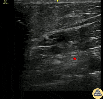 Nerve Block Gallery - Popliteal Sciatic Nerve Block for Lac Repair
