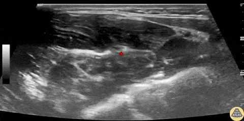 Nerve Block Gallery - Median Nerve Block