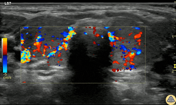 Soft Tissue - Pediatric Thyrotoxicosis
