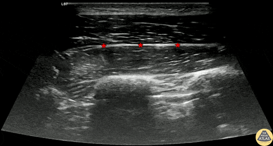Nerve Block Gallery - Serratus Anterior Block