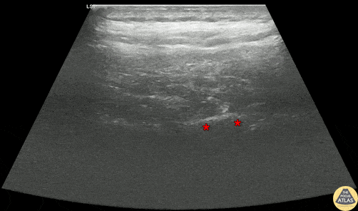 Nerve Block Gallery - Erector Spinae Plane Block for Pancreatitis