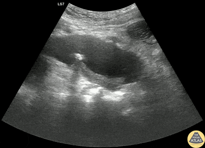 Aorta - Thrombosed Type B Aortic Dissection