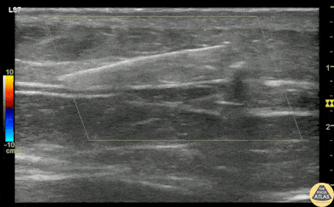 Soft Tissue - Glass Foreign Body Removal