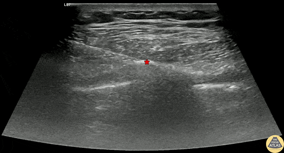 Nerve Block Gallery - Serratus Anterior Plane Block for Herpes Zoster