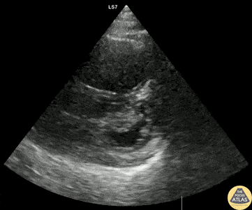 Right Ventricular Dysfunction - RV Dysfunction and Pulmonary Hypertension from COPD