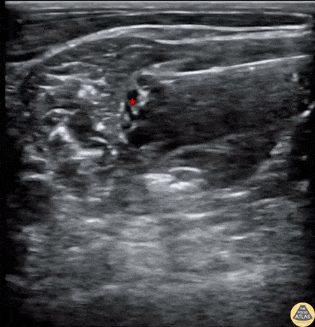 Nerve Block Gallery - Interscalene Brachial Plexus Block for Recurrent Shoulder Dislocation