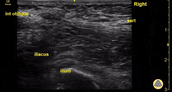 Nerve Block Gallery - Suprainguinal Nerve Block