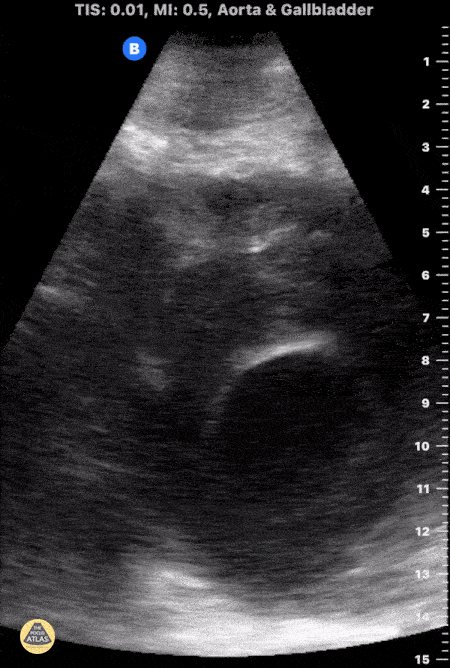 Aorta - Large AAA Rupture