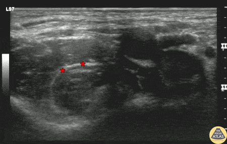 Nerve Block Gallery - Fascia Iliaca Block for Intertrochanteric Femur Fracture