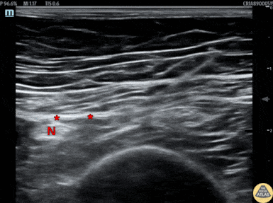 Nerve Block Gallery - Fascia Iliaca Compartment Block for Hip Fracture
