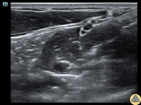Nerve Block Gallery - Interscalene Brachial Plexus Block for Shoulder Dislocation