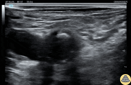 Nerve Block Gallery - Fascia Iliaca Block for Femoral Neck Fracture