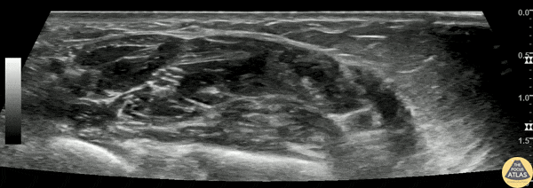 Nerve Block Gallery - Median Nerve Block for Carpal Tunnel Syndrome