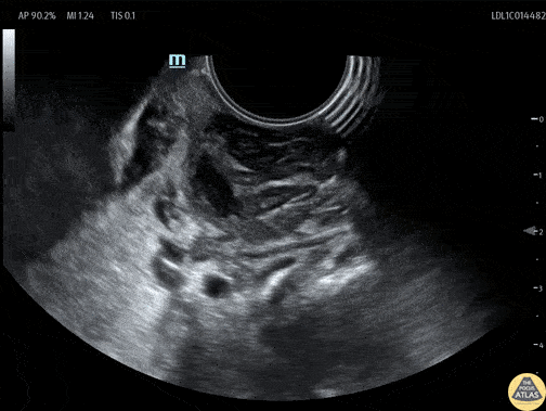 Soft Tissue - Tonsillar Abscess