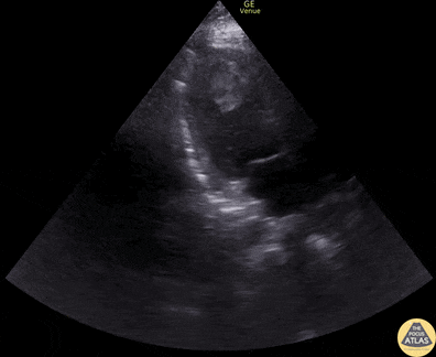 Other Cardiac Pathology - LV Thrombus