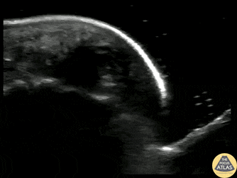Musculoskeletal - Fingertip Felon