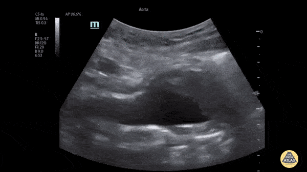Aorta - AAA with Intramural Thrombus