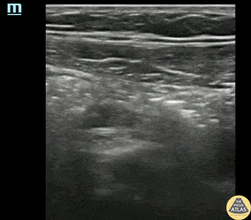 Peds-Gastrointestinal - Normal appendix