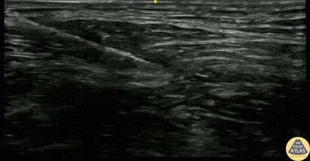Nerve Block Gallery - Popping through the Fascia Iliaca