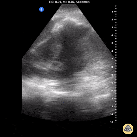 Renal/GU - Perinephric Abscess