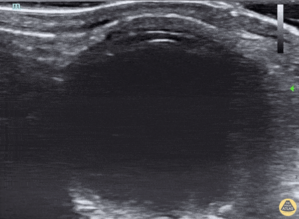 Orbital - Anterior Lens Dislocation and Retinal Detatchment