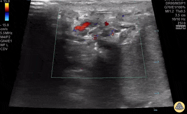 Peds-Genitourinary - Whirlpool Sign