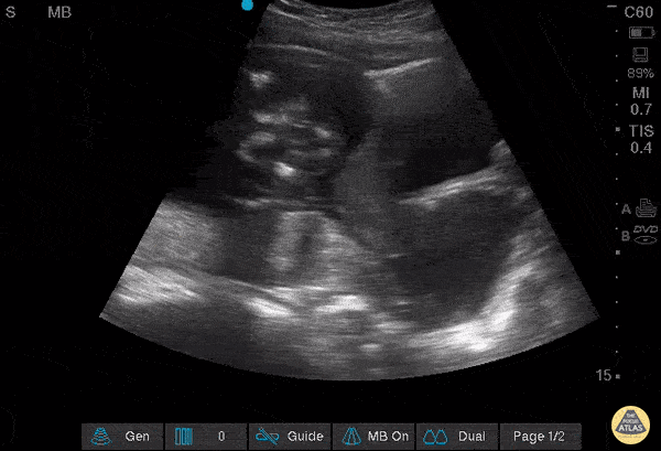 OB/Gyn - Dilated Cervix with intact membranes protruding out